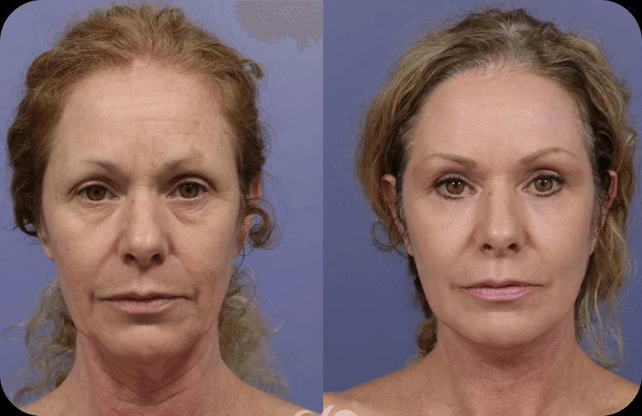Before and after comparison showing improved skin appearance